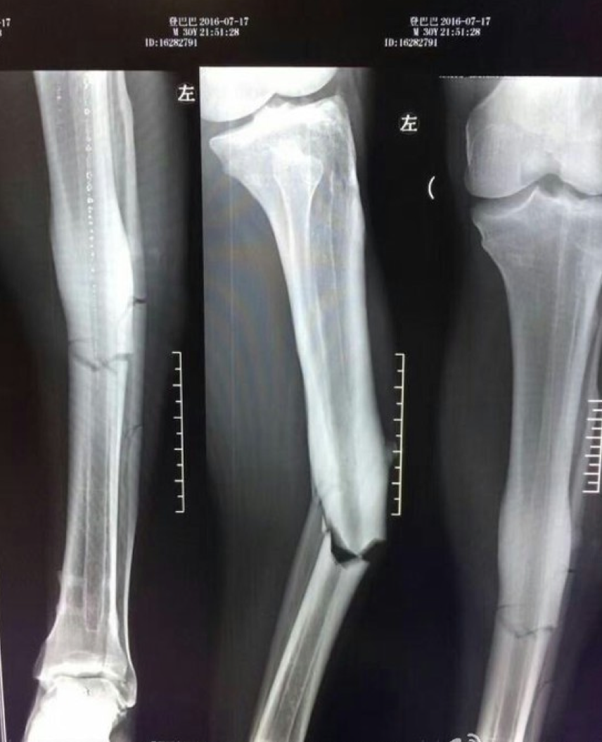 Demba Ba S Broken Leg X Ray Revealed Goal Com